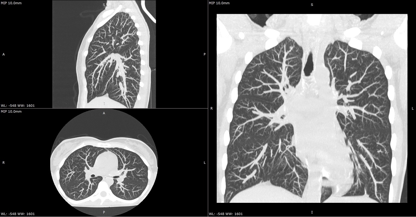 diagnostico-precoz-cancer-pulmon